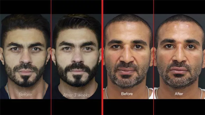 بعد خالد سليم .. رواد السوشيال ميديا يهاجمون أحمد سعد بسبب عمليات التجميل
