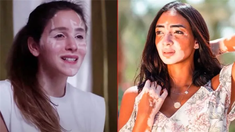 لُجينة صلاح : جميلة عوض نقلت قصتي مع البهاق بواقعية في حكاية لازم أعيش